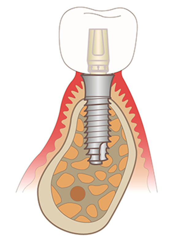 インプラントセラピー IMPLANT THERAPY オルソインプラントセラピー - クインテッセンス出版